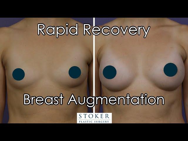 Rapid Recovery Breast Augmentation: Los Angeles Top Breast Surgeon Dr. David Stoker Describes