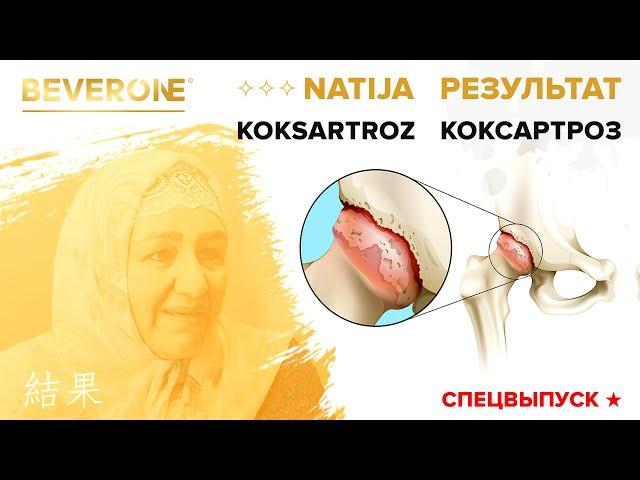 Коксартроз - Результат | BEVERONE