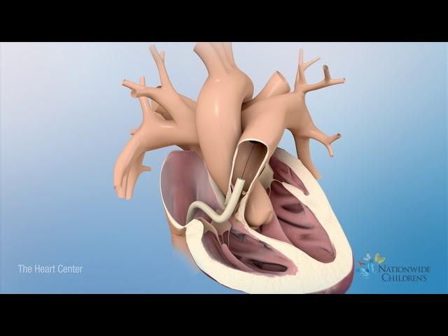 Tetralogy of Fallot (TOF): Animation Explains Heart Defect and Repair