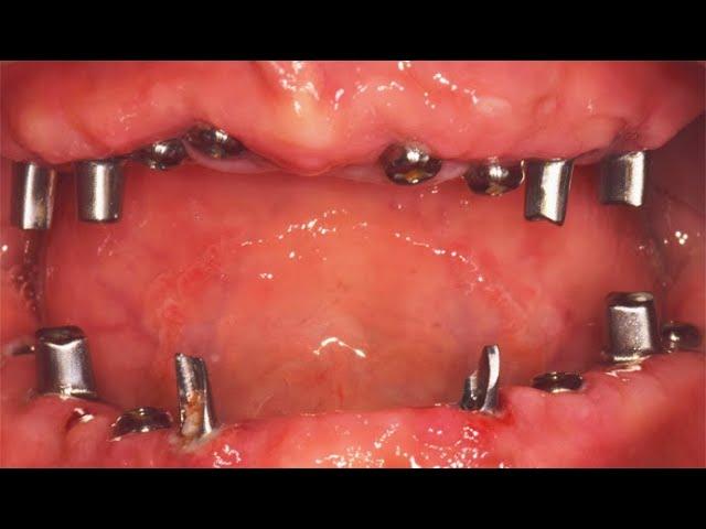 Full mouth rehabilitation with Dentium Guide on edentulous state ‘done in 1 hour'_Dr.Kang-Hee Lee