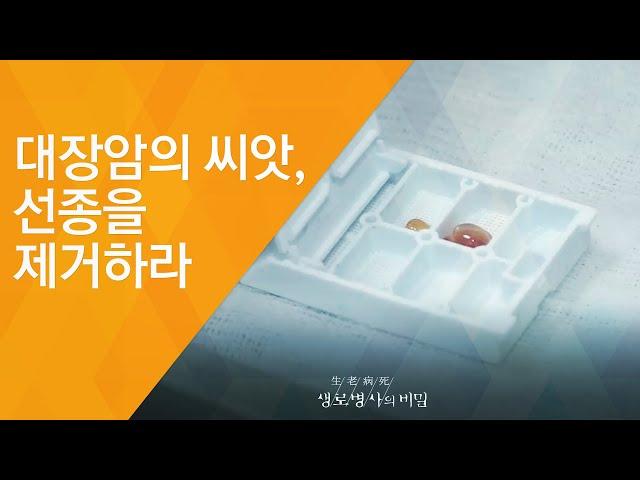 대장암의 씨앗, 선종을 제거하라 - (2017.6.7_623회 방송)_발병률 1위, 대장암을 극복하라