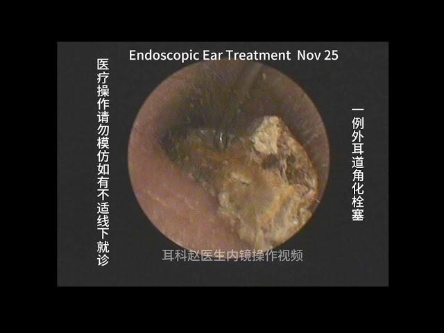 Management of a case of ear canal keratinization embolism 20241125