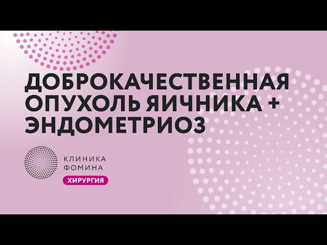 доброкачественная опухоль яичника + эндометриоз // Клиника Фомина.Обучаем