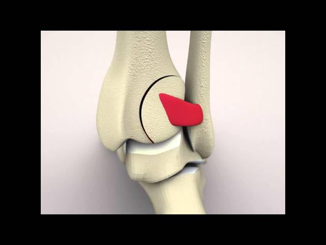 PER - Posterior Malleolar Fracture with Syndesmotic Rupture and Subsequent Diastasis