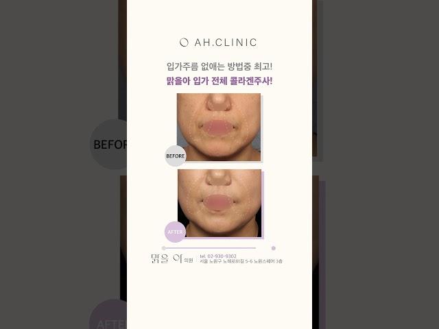 입가 주름 없애는 방법 중 최고!맑을아 입가 전체 콜라겐 주사!  #콜라겐주사 #입가주름 #치마주름 ##고양이주름 #괄호주름 #아코디언주름 #상어주름 #입가노화 #베이비콜라겐