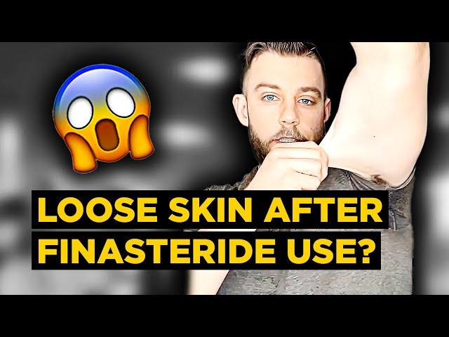 STRANGE Side Effects from Post-Finasteride Syndrome Sufferer... LOOSE SKIN?! | Mark's PFS Experience