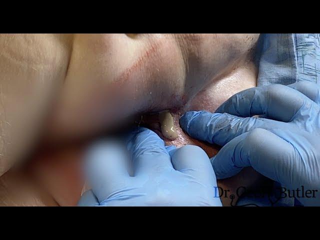 Drainage of an Ischiorectal Abscess (READ CAPTION)