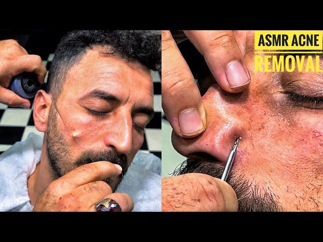 Asmr Turkish Barber Massage • Minor acne and hair removal