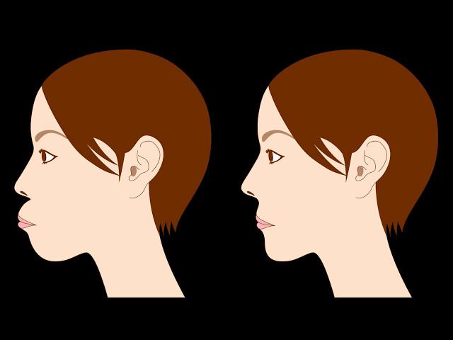 Contouring(Overbite Treatment) -Upper and lower jaw osteotomy