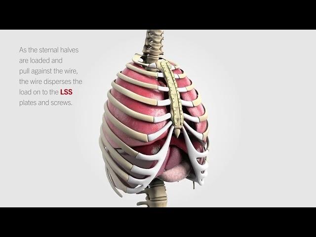 Longitudinal Sternal Stabilization (LSS)