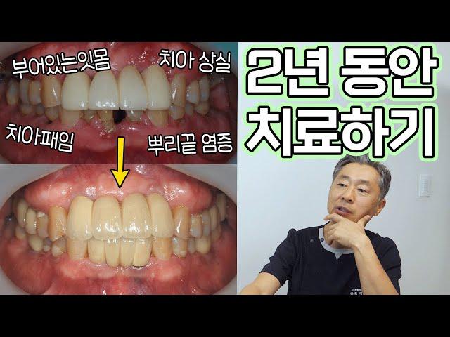 2년에 걸쳐 완성한 11개의 임플란트!! 그리고 신경치료와 발치까지..!