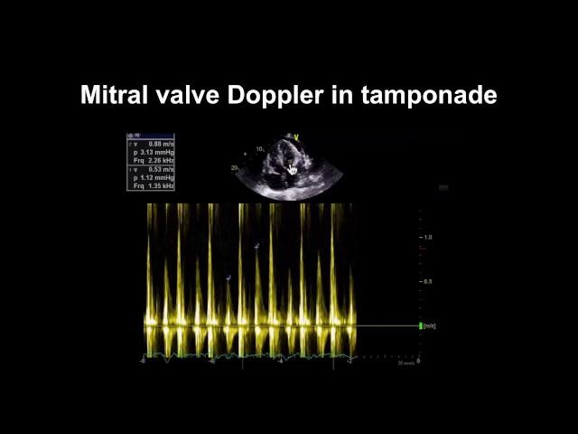 Echocardiography Essentials: Detecting pericardial effusions