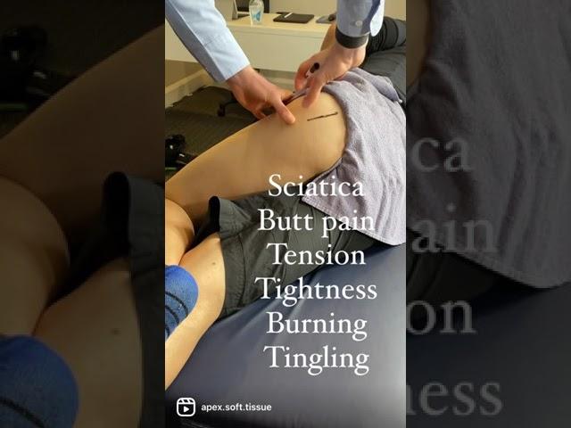 Sciatic Nerve Entrapment at the deep gluteal space (posterior hip)