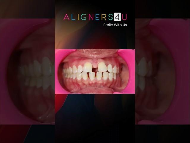 TEETH STRAIGHTENING WITH ALIGNERS4U #shorts #aligners #teeth #dental #invisalign #hyderabad #smile