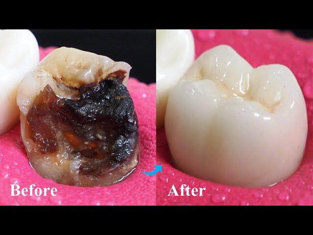 Incredible Restoration Of Tooth By Root Canal And Zirconia Crown.