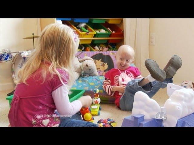 Living With Rapid-Aging Disease Progeria