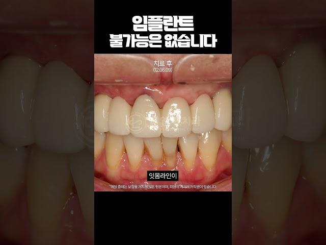 당뇨? 잇몸병? 이런 이유로 임플란트 포기하지 마세요.