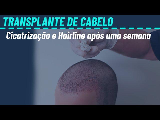 Transplante capilar após uma semana