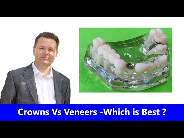 Crowns Vs Veneers - Which is best?