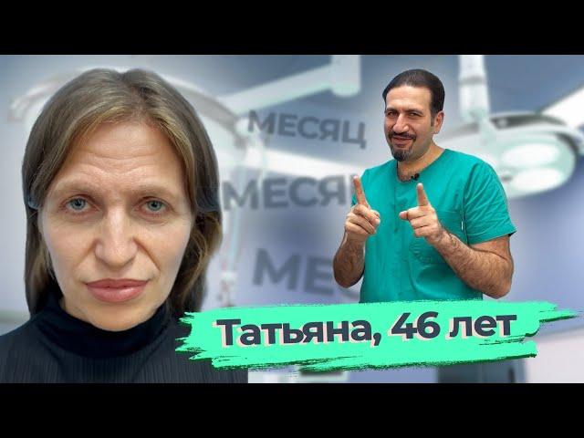 Омоложение лица,  ринопластика,  липофиллинг подбородка: Татьяна, 46 лет