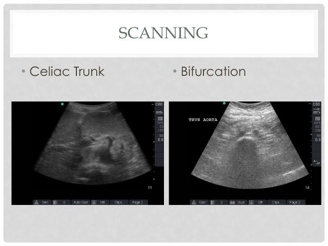 UH CMC ED Ultrasound Cases: #2 AAA