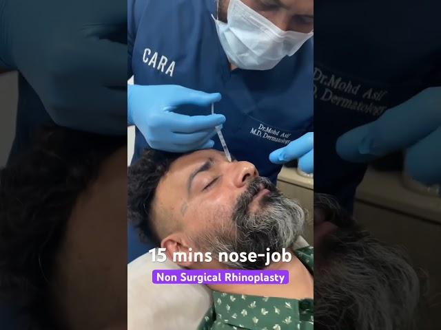 Non surgical rhinoplasty | Instant nose job results in just 15 mins