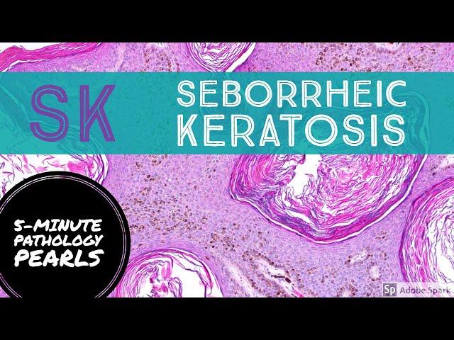 Seborrheic Keratosis: 5-Minute Pathology Pearls