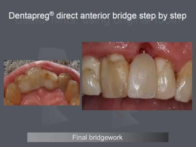 Composite Anterior Bridge with Dentapreg by Dr. Eric Van Zytveld