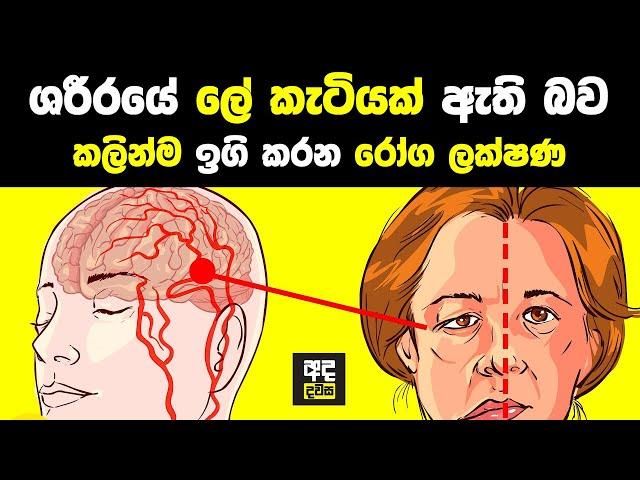 ශරීරයේ ලේ කැටියක් තියෙනකොට මෙන්න මේ ලක්ෂණ ඇති වෙන්න පටන් ගන්නවා | Blood Stroke Signs in Your Body