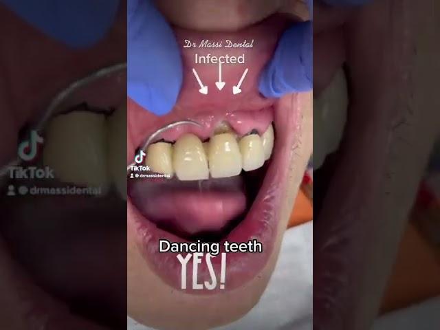 Dancing teeth! Loose teeth , Infected teeth with mobility