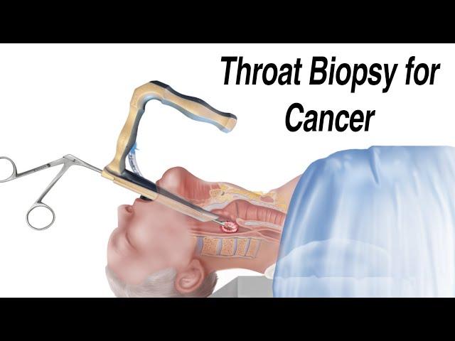 How a Throat Biopsy is Performed to Check for Throat Cancer