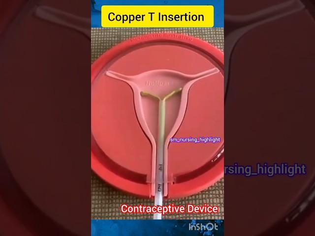 IUD insertion|Copper T insertion | Intrauterine device #iucd #iud  #iudinsertion#copperiud#shorts