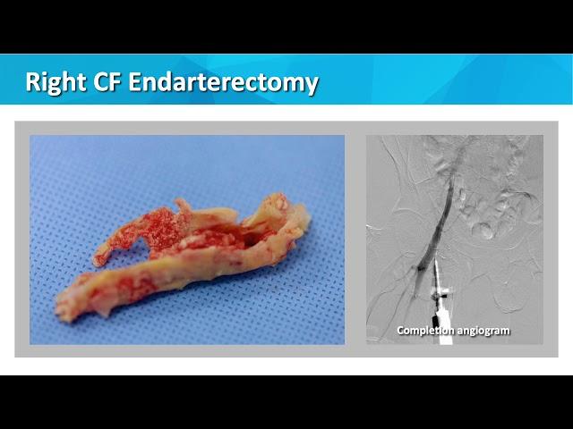 A Case of Hybrid approach to multilevel CLI - Eric Scott, MD