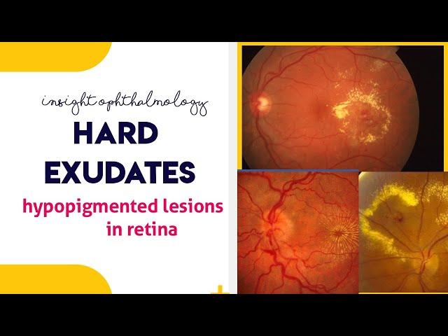 HARD EXUDATES || Hypopigmented lesions of the retina ||