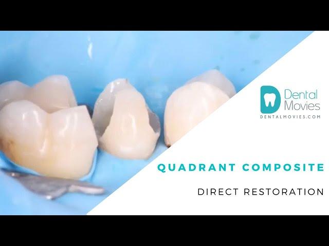 Quadrant composite direct restoration