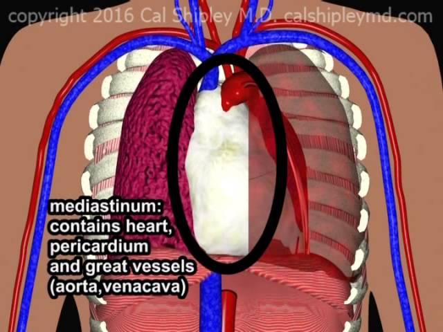 Hemothorax due to aortic rupture in aortic dissection by Cal Shipley, M.D.