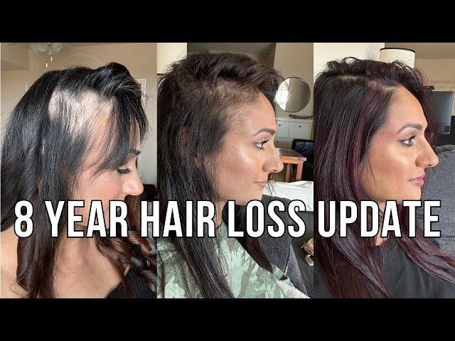 8 Year Hair Loss Update