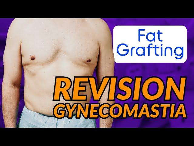 Revision Gynecomastia Surgery: Correcting a Botched Chest (Fat Grafting & Fat Flap)