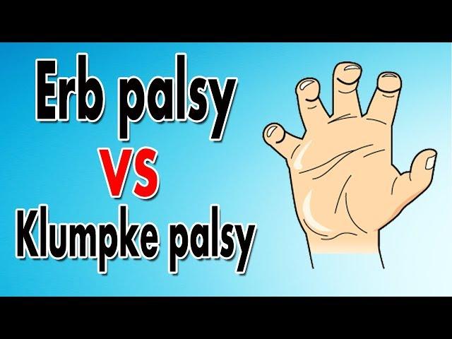 Erb's Palsy vs. Klumpke's Palsy