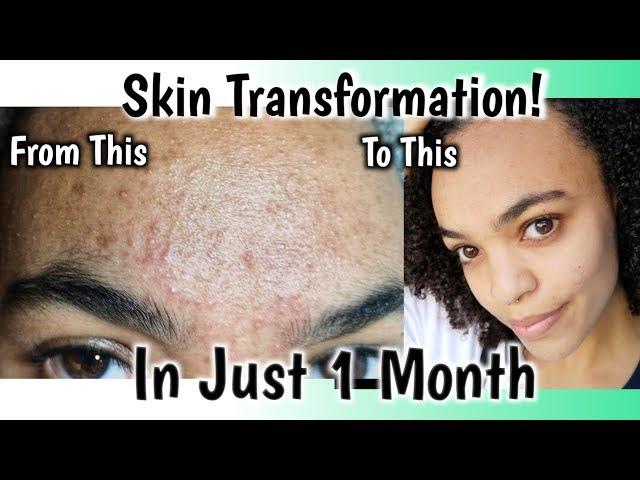 How I Got Rid Of My Acne In Just ONE Month! | Zineryt - Zinc For Acne