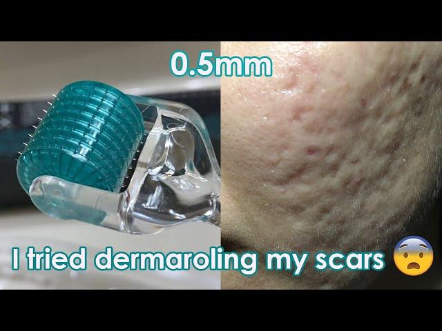 I tried dermarolling my ACNE SCARS! | Demo + Review