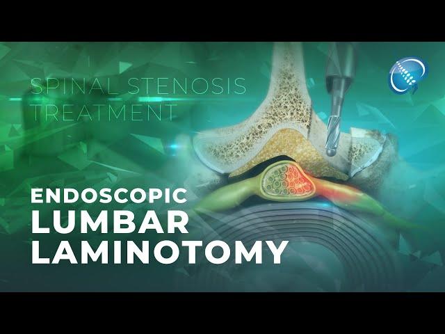 What is Endoscopic Lumbar Laminotomy? | Laminectomy