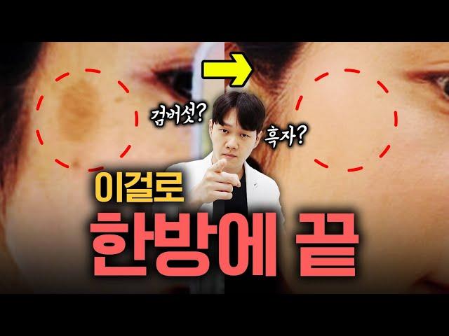 레이저 10번 하지 말고 딱 한방에 끝내기 | 검버섯, 잡티, 흑자 피부과 시술, 리팟