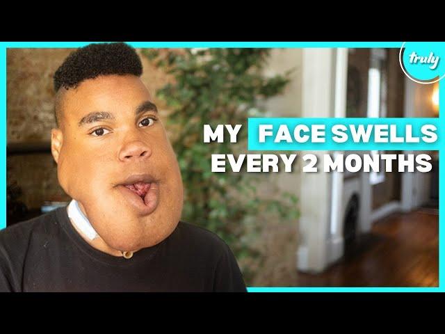 My Giant Facial Tumour Won’t Stop Me Dancing | BORN DIFFERENT