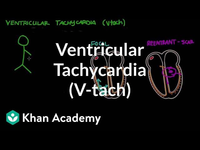 Ventricular tachycardia (Vtach) | Circulatory System and Disease | NCLEX-RN | Khan Academy