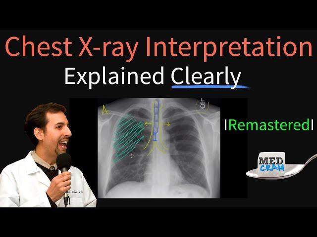 Chest X Ray Interpretation Explained Clearly - How to read a chest Xray