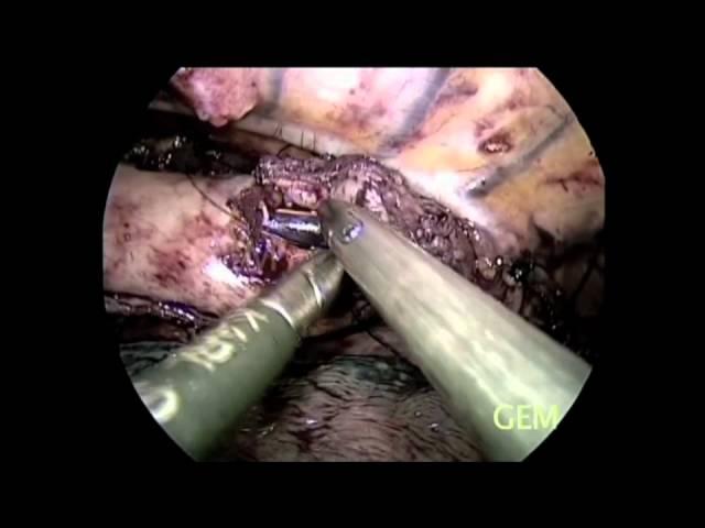 SS15 Best of Video:V034. MINIMALLY INVASIVE ESOPHAGO-GASTRECTOMY WITH INTRA THORACIC ANASTOMOSIS