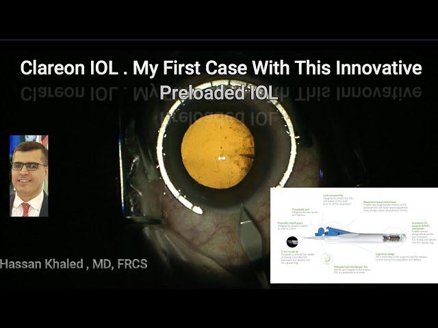 Clareon IOL, my first case with this innovative delivery system.