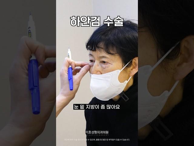 중년 눈성형  하안검 상담받고 수술한 2달차 후기 (미호 시그니처 눈밑성형)