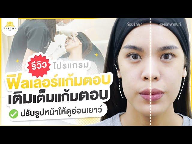 รีวิวฟิลเลอร์แก้มตอบ แก้ปัญหากระเปราะแก้ม ใบหน้าหย่อนคล้อย